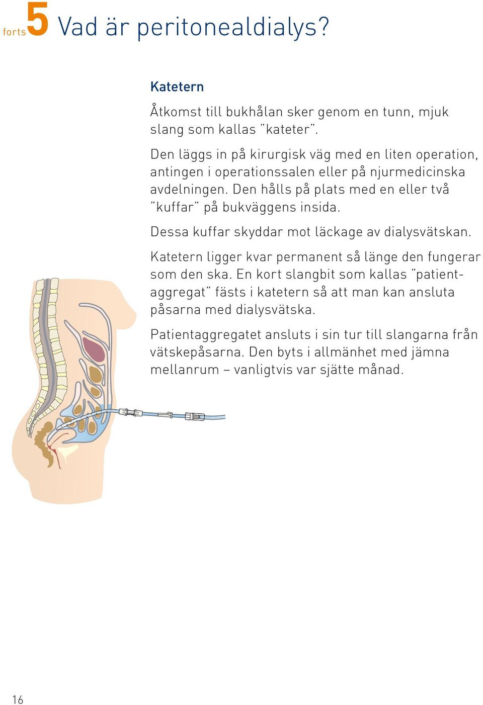 Den hålls på plats med en eller två kuffar på bukväggens insida. 3. Dessa kuffar skyddar mot läckage av dialysvätskan. 4.