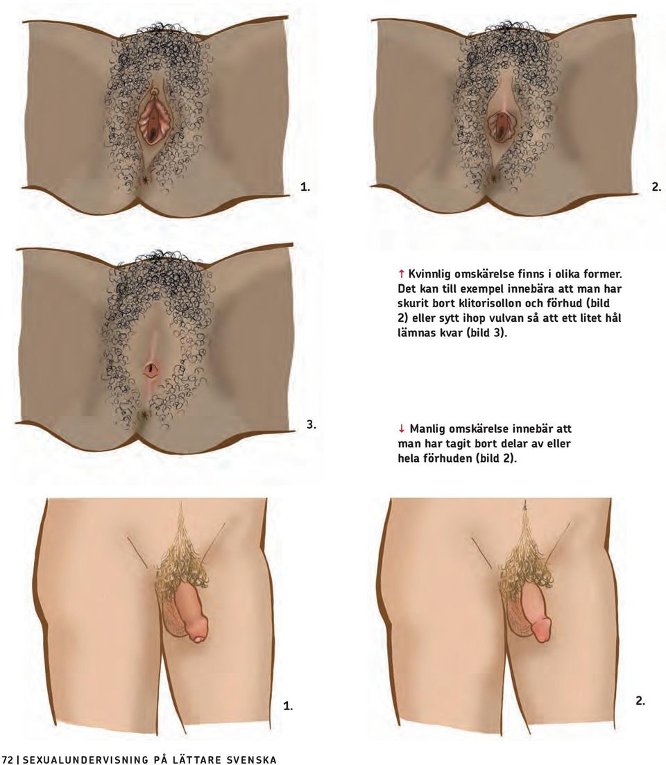 2) eller sytt ihop vulvan så att ett litet hål lämnas kvar (bild 3)