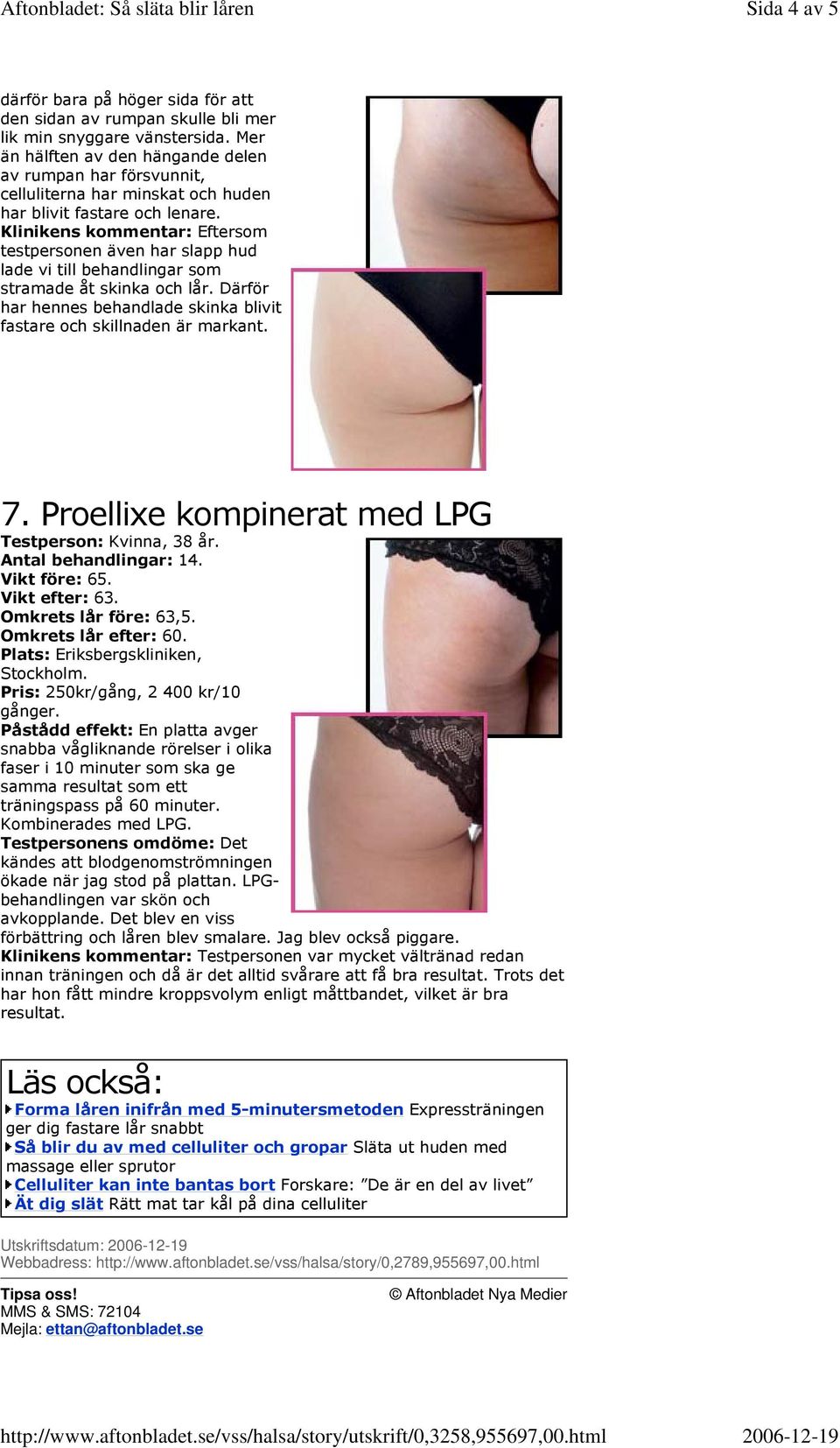 Klinikens kommentar: Eftersom testpersonen även har slapp hud lade vi till behandlingar som stramade åt skinka och lår. Därför har hennes behandlade skinka blivit fastare och skillnaden är markant. 7.