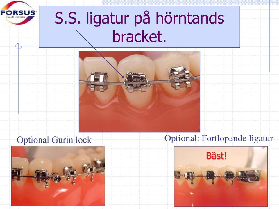 Optional Gurin lock