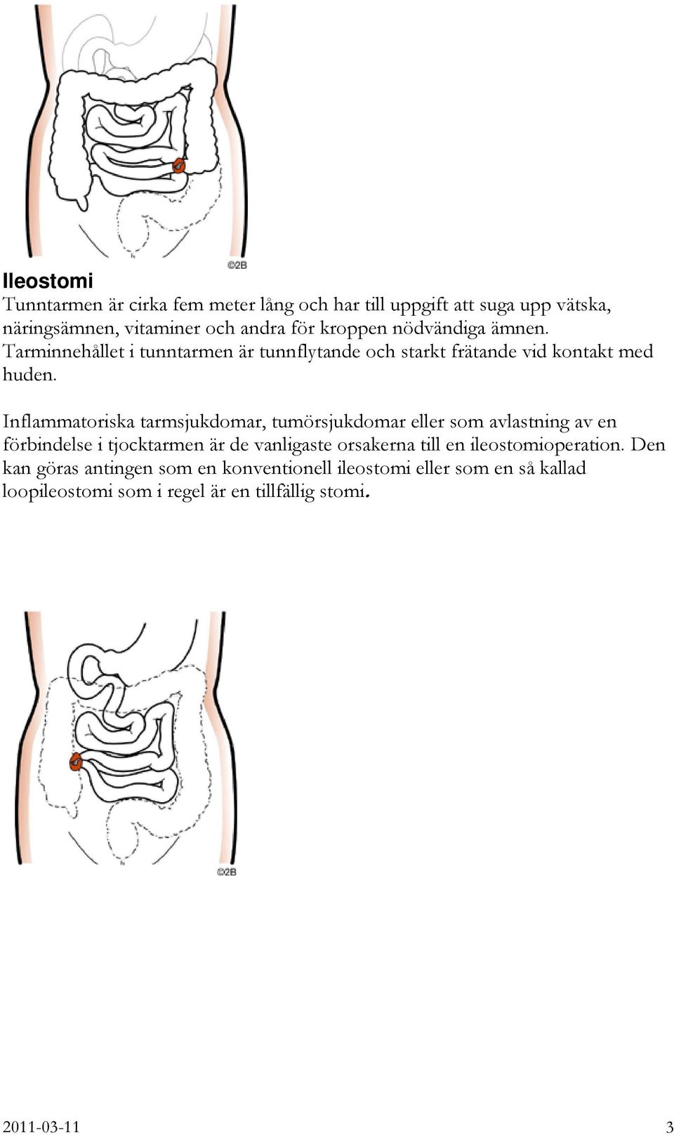 Inflammatoriska tarmsjukdomar, tumörsjukdomar eller som avlastning av en förbindelse i tjocktarmen är de vanligaste orsakerna till