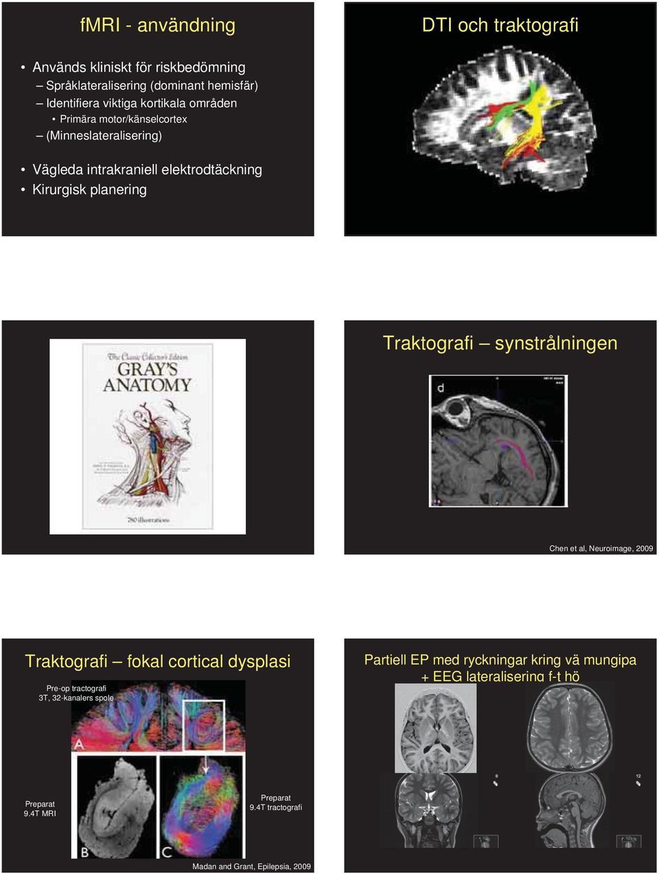 Traktografi synstrålningen Chen et al, Neuroimage, 2009 Traktografi fokal cortical dysplasi Pre-op tractografi 3T, 32-kanalers spole