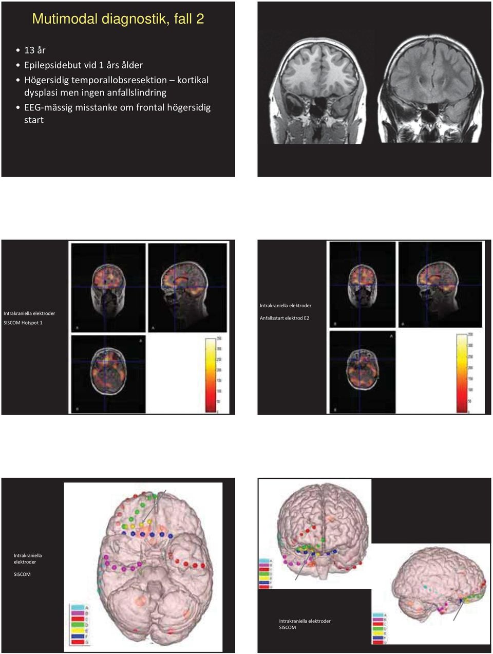 Intrakraniella elektroder SISCOM Hotspot 1 Intrakraniella elektroder Anfallsstart elektrod E2