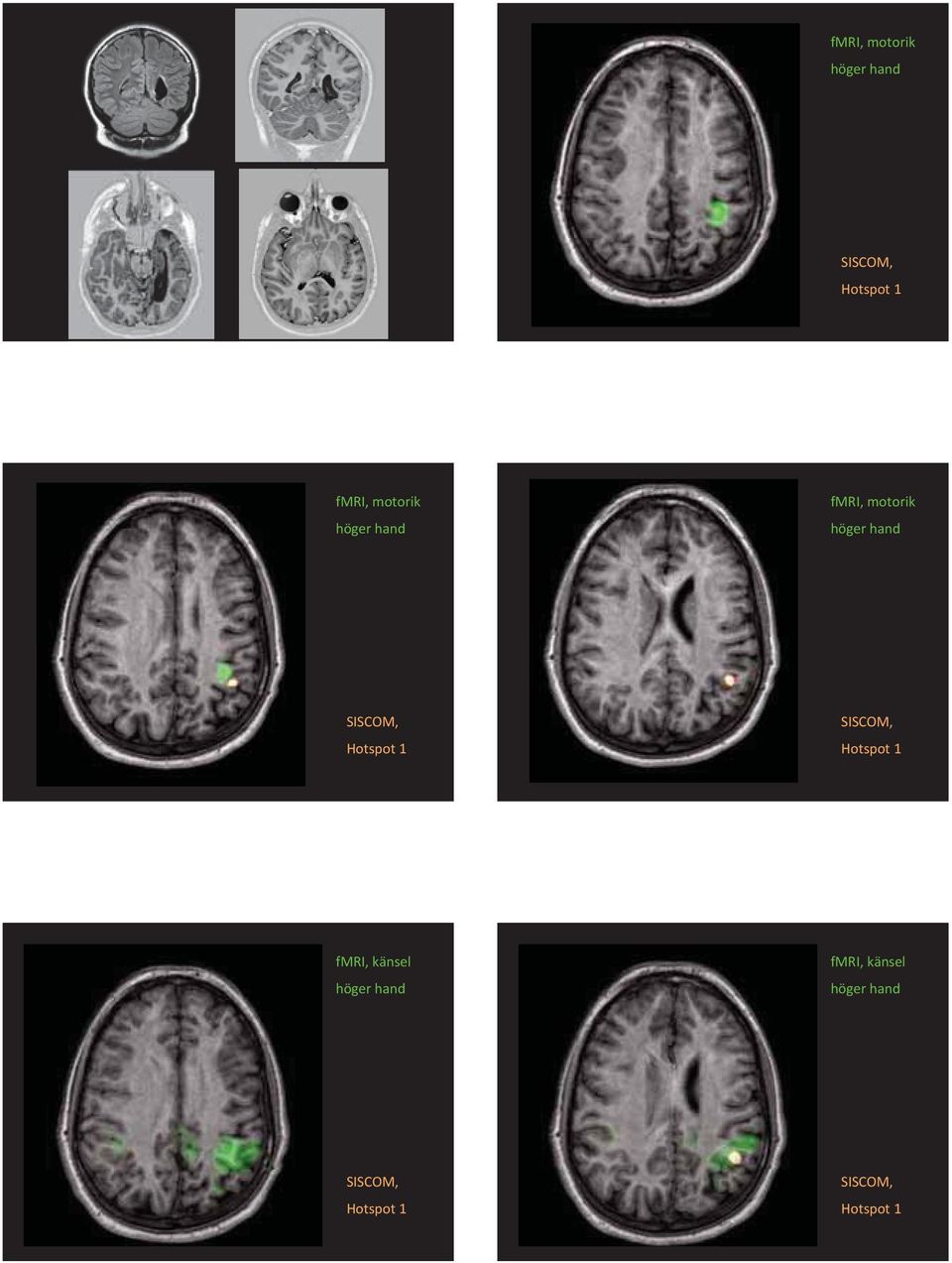 Hotspot 1 SISCOM, Hotspot 1 fmri, känsel höger hand