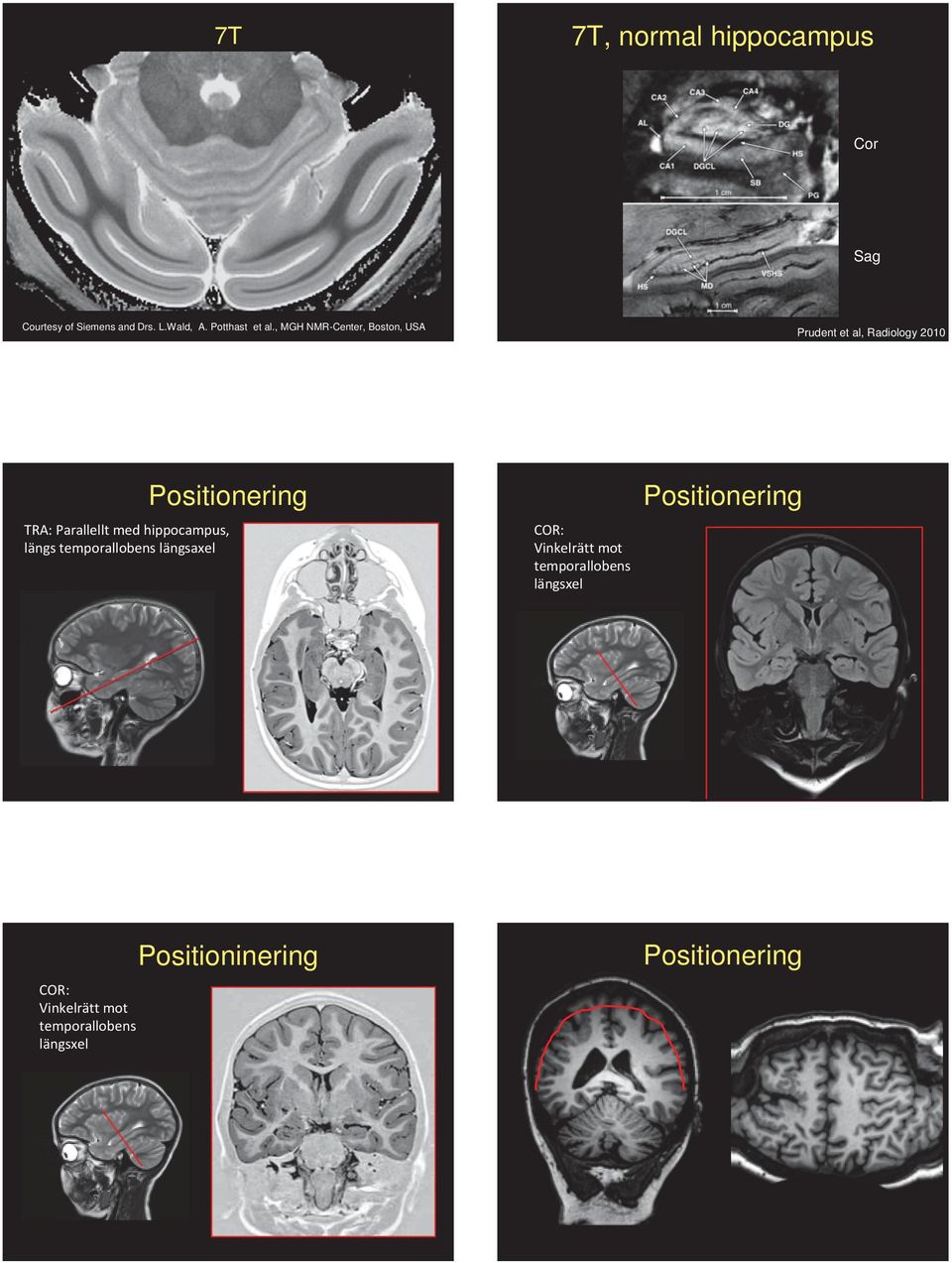 med hippocampus, längs temporallobens längsaxel COR: Vinkelrätt mot temporallobens