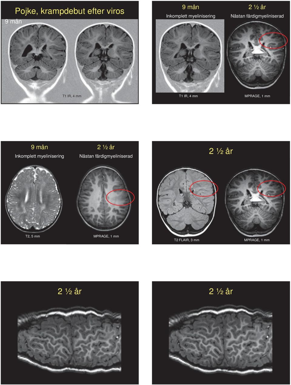 mm 9 mån Inkomplett myelinisering 2 ½ år Nästan färdigmyeliniserad
