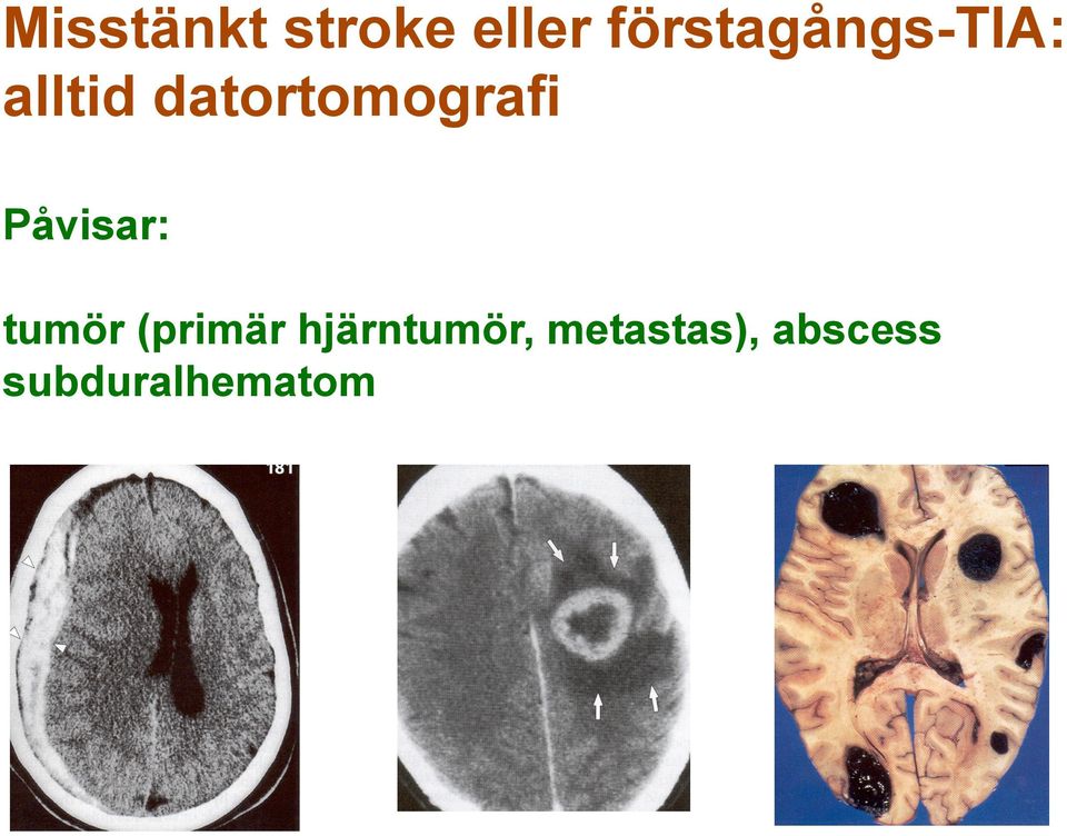 datortomografi Påvisar: tumör