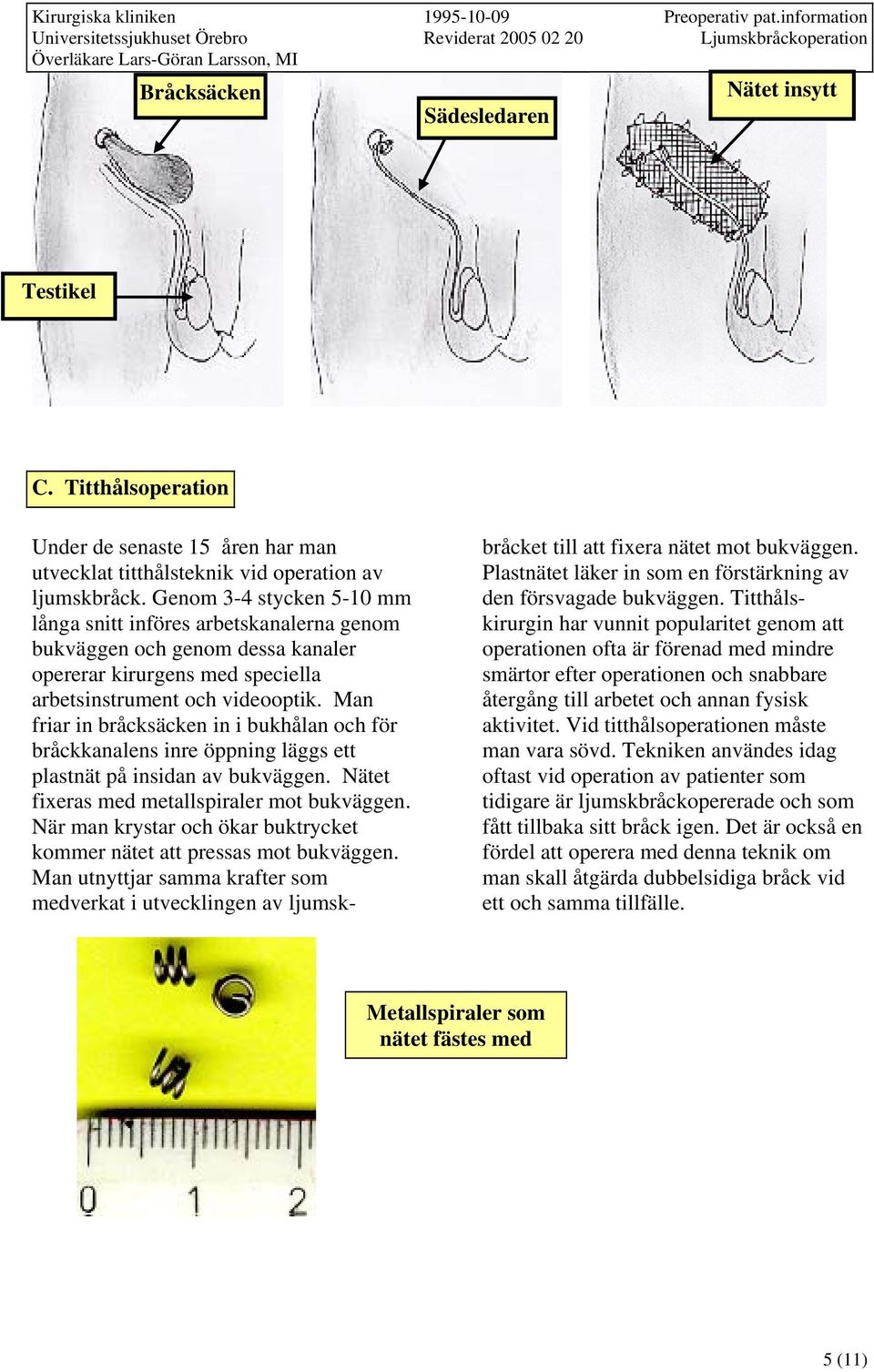 Man friar in bråcksäcken in i bukhålan och för bråckkanalens inre öppning läggs ett plastnät på insidan av bukväggen. Nätet fixeras med metallspiraler mot bukväggen.