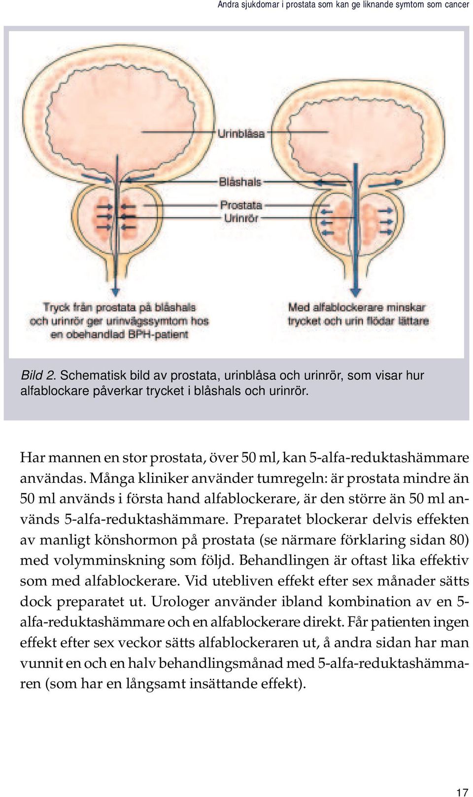 Många kliniker använder tumregeln: är prostata mindre än 50 ml används i första hand alfablockerare, är den större än 50 ml används 5-alfa-reduktashämmare.