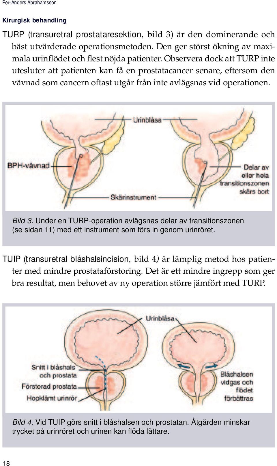Observera dock att TURP inte utesluter att patienten kan få en prostatacancer senare, eftersom den vävnad som cancern oftast utgår från inte avlägsnas vid operationen. Bild 3.