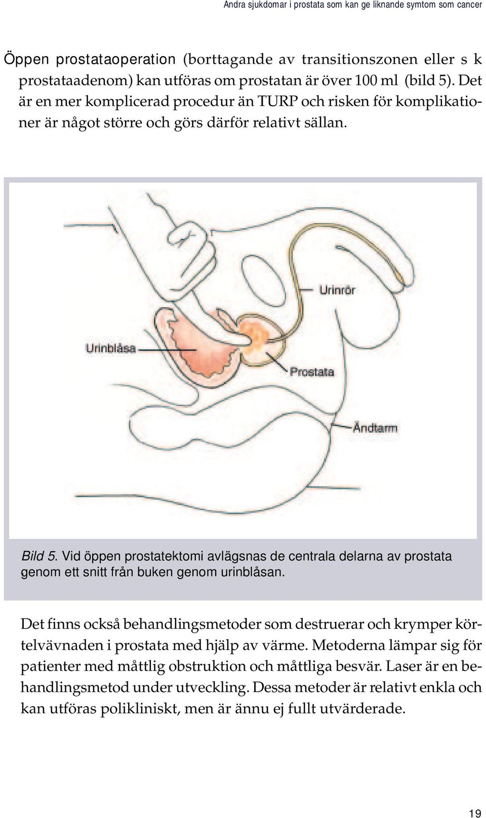 Vid öppen prostatektomi avlägsnas de centrala delarna av prostata genom. ett snitt från buken genom urinblåsan.