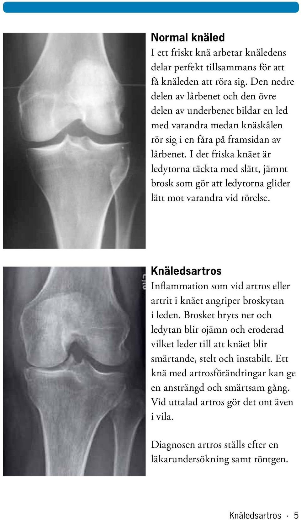 I det friska knäet är ledytorna täckta med slätt, jämnt brosk som gör att ledytorna glider lätt mot varandra vid rörelse.