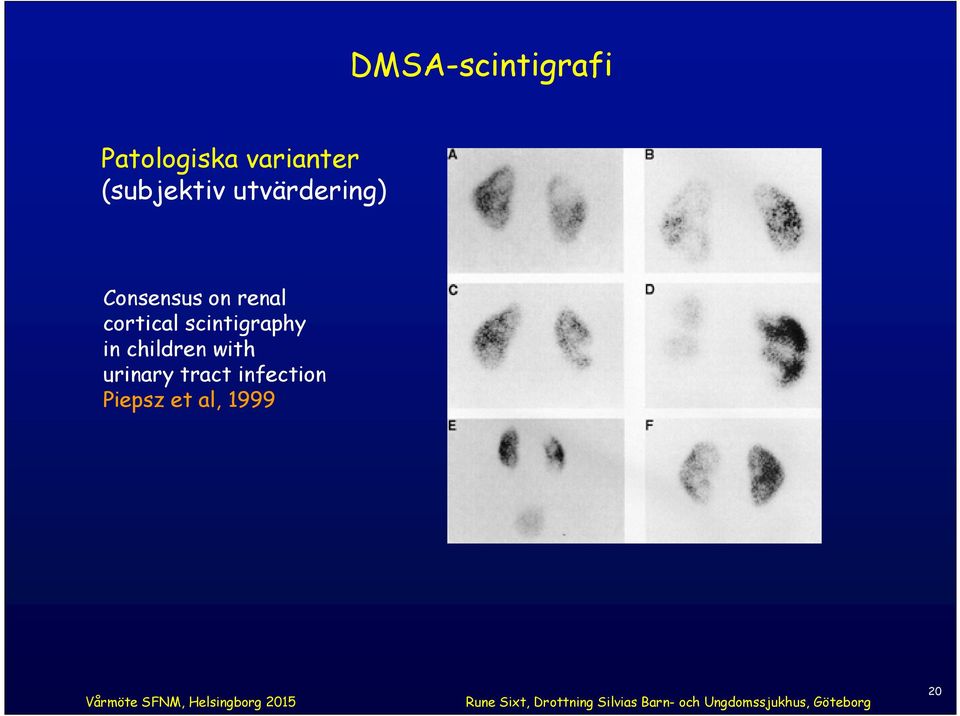 renal cortical scintigraphy in children