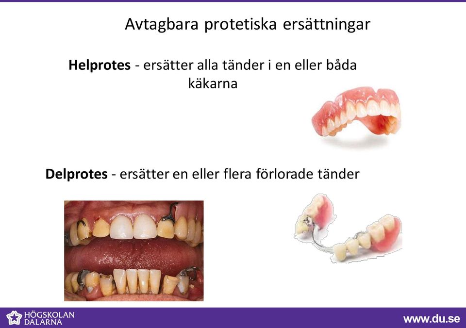 en eller båda käkarna Delprotes -