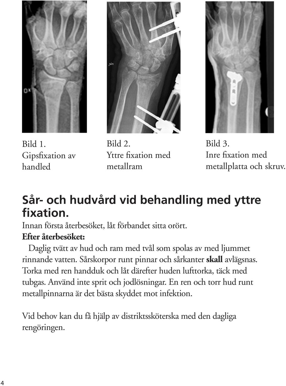 Efter återbesöket: Daglig tvätt av hud och ram med tvål som spolas av med ljummet rinnande vatten. Sårskorpor runt pinnar och sårkanter skall avlägsnas.