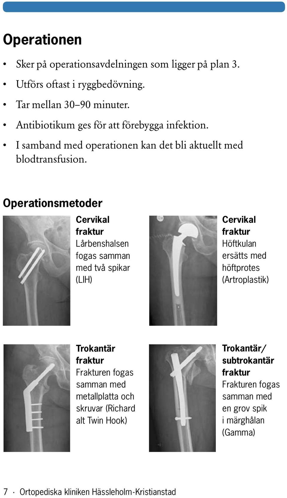Operationsmetoder Cervikal fraktur Lårbenshalsen fogas samman med två spikar (LIH) Cervikal fraktur Höftkulan ersätts med höftprotes (Artroplastik)