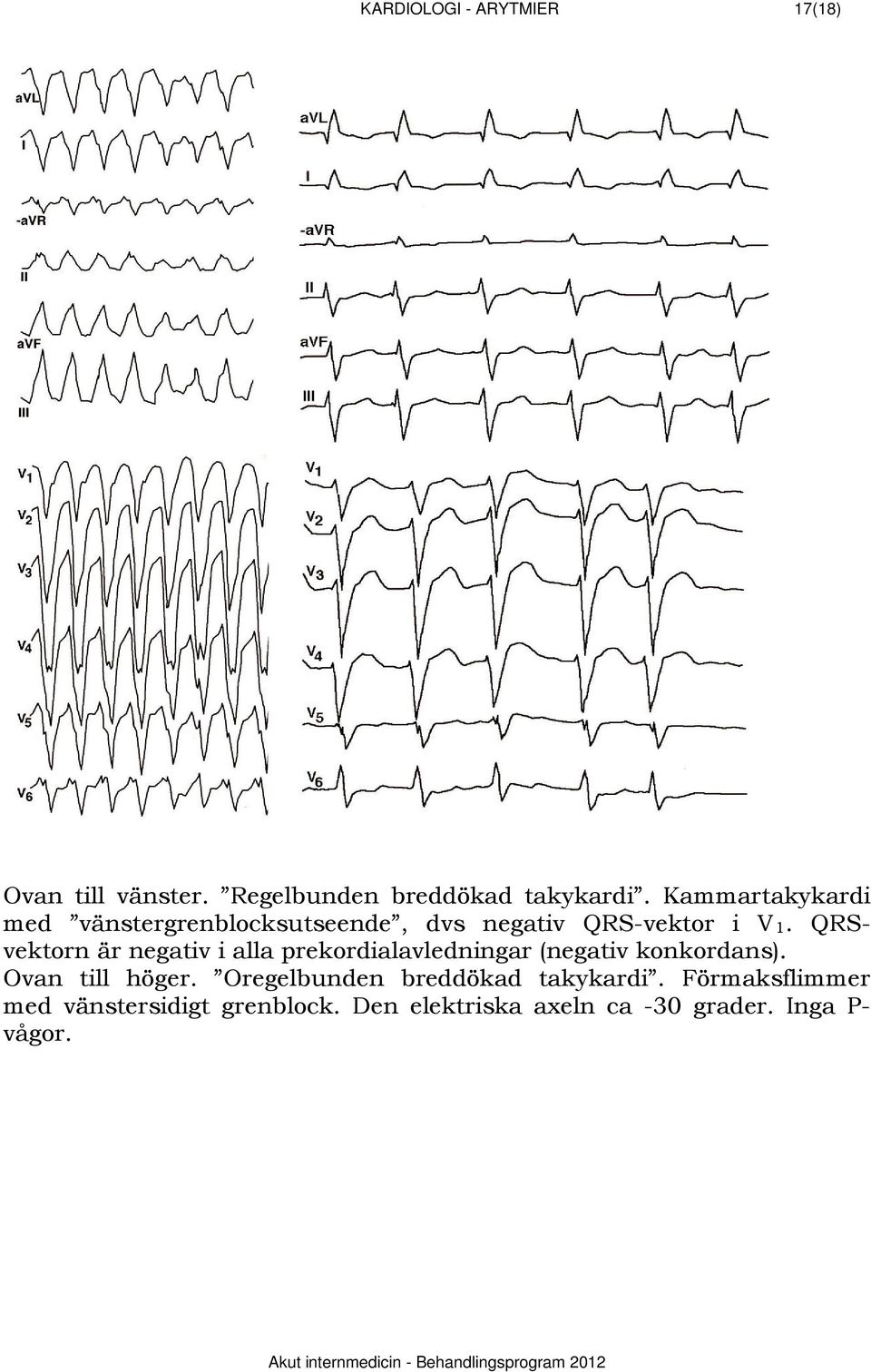 QRSvektorn är negativ i alla prekordialavledningar (negativ konkordans). Ovan till höger.