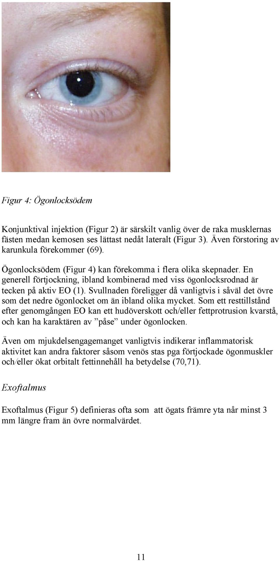 En generell förtjockning, ibland kombinerad med viss ögonlocksrodnad är tecken på aktiv EO (1). Svullnaden föreligger då vanligtvis i såväl det övre som det nedre ögonlocket om än ibland olika mycket.