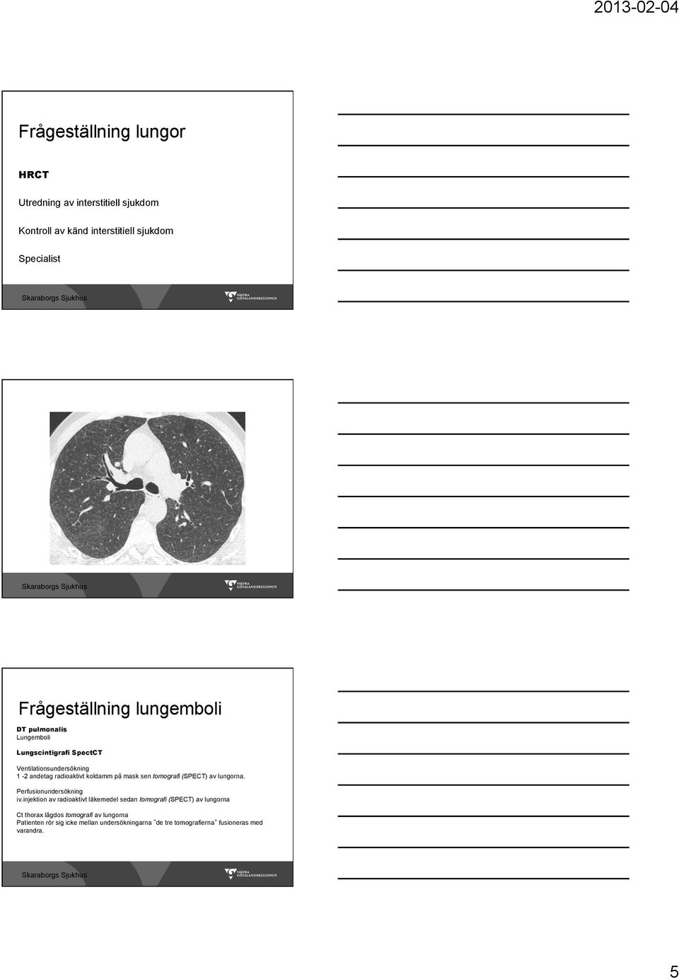 tomografi (SPECT) av lungorna. Perfusionundersökning iv.