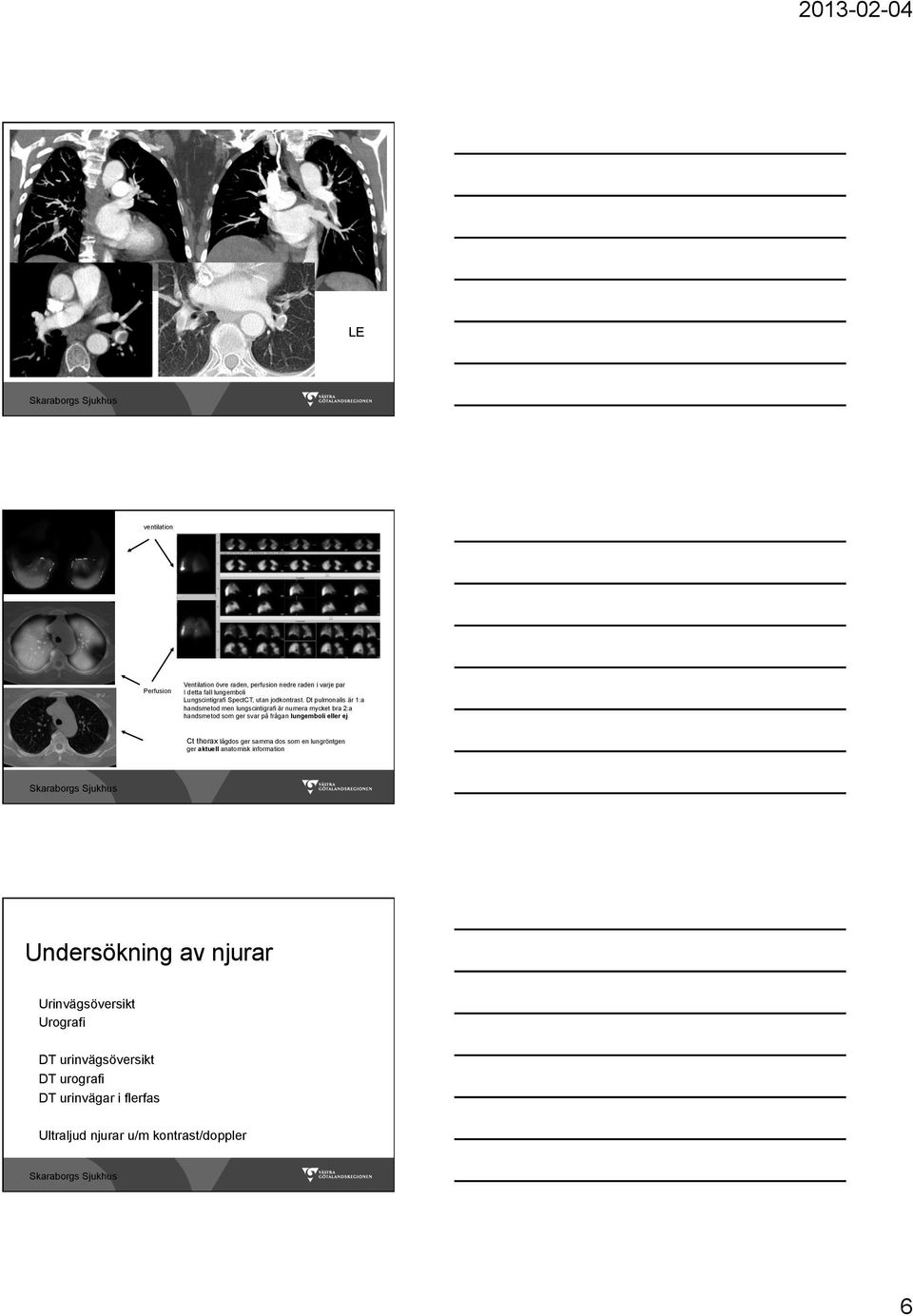 Dt pulmonalis är 1:a handsmetod men lungscintigrafi är numera mycket bra 2:a handsmetod som ger svar på frågan lungemboli