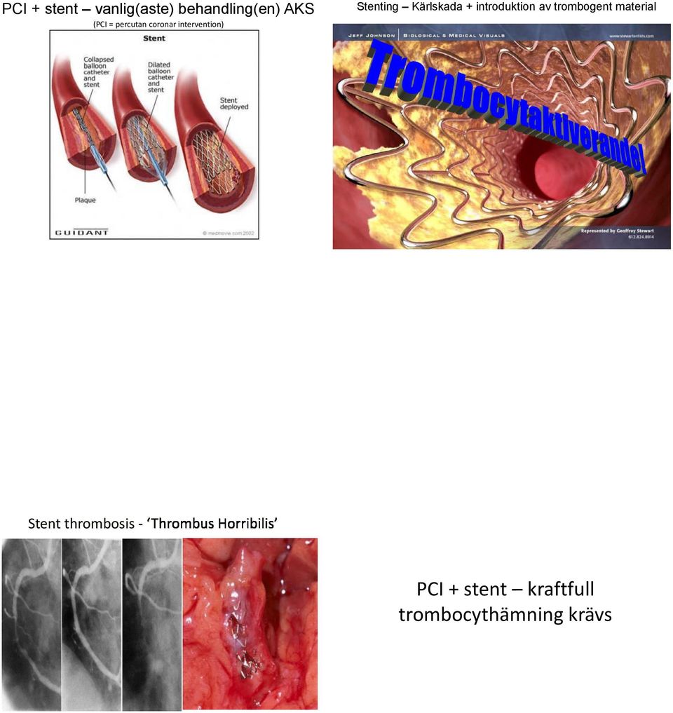 material (PCI = percutan coronar intervention)