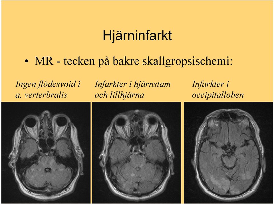 a. verterbralis Infarkter i hjärnstam