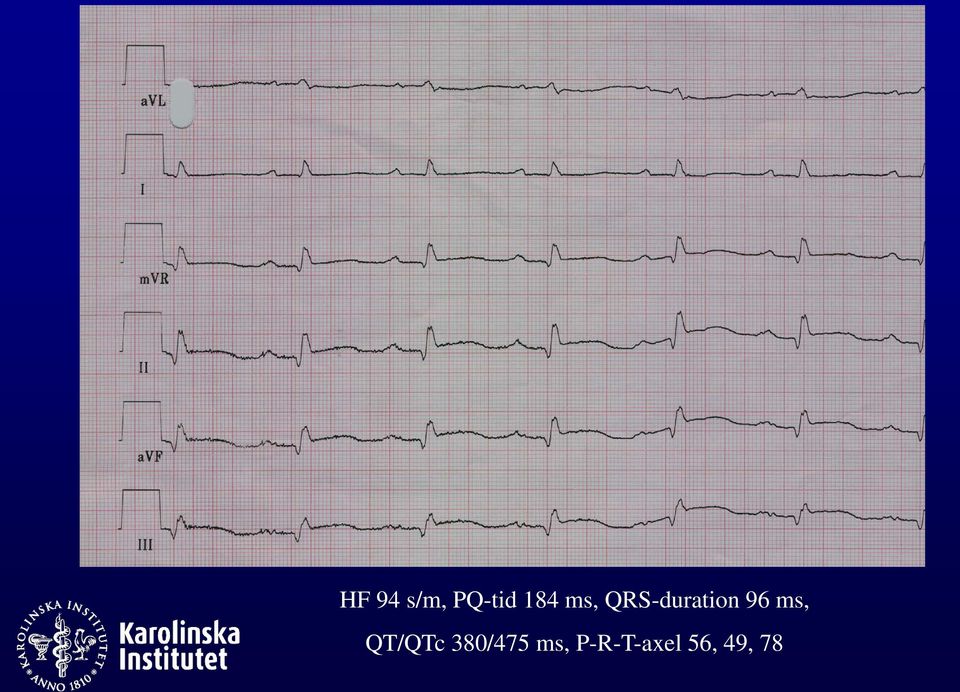 ms, QT/QTc 380/475