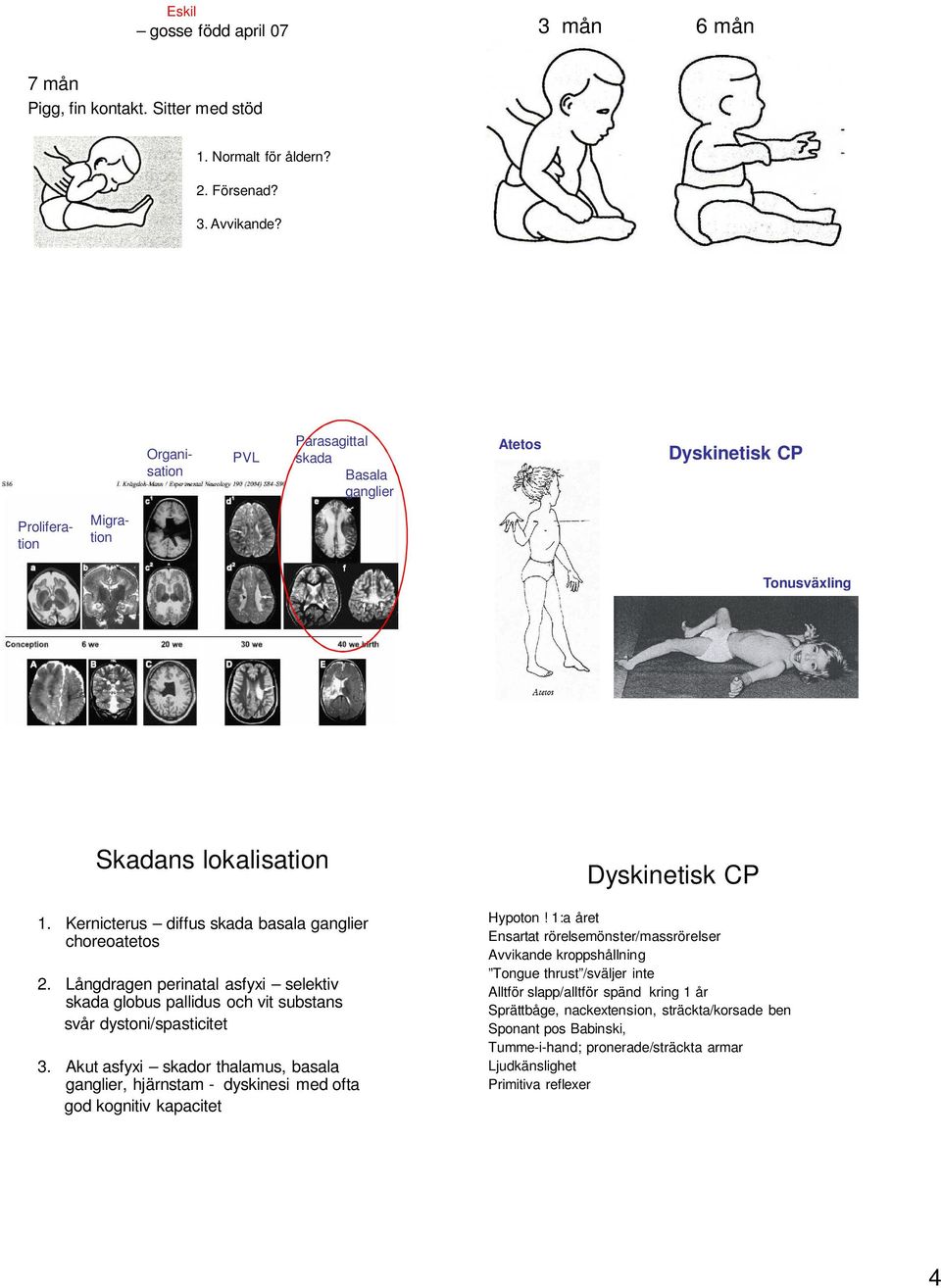 Långdragen perinatal asfyxi selektiv skada globus pallidus och vit substans svår dystoni/spasticitet 3.