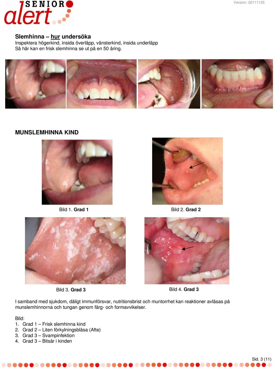 Grad 3 I samband med sjukdom, dåligt immunförsvar, nutritionsbrist och muntorrhet kan reaktioner avläsas på munslemhinnorna och