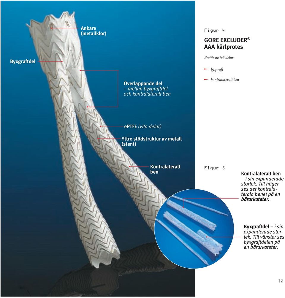 (stent) Kontralateralt ben Figur 5 Kontralateralt ben i sin expanderade storlek.