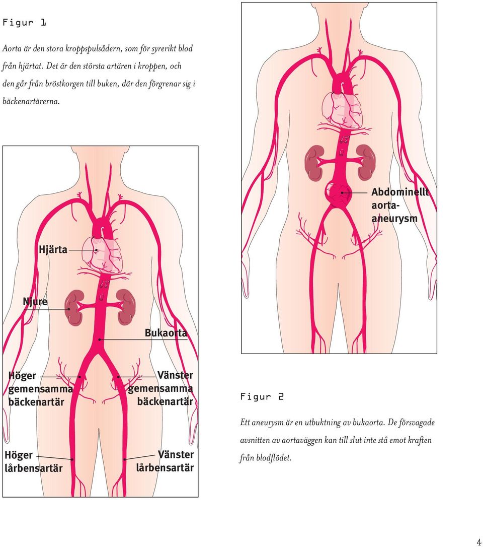 Abdominellt aortaaneurysm Hjärta Njure Bukaorta Höger gemensamma bäckenartär Höger lårbensartär Vänster gemensamma