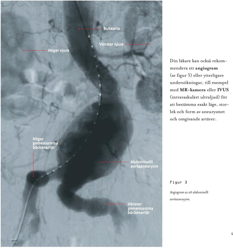 bestämma exakt läge, storlek och form av aneurysmet och omgivande artärer.