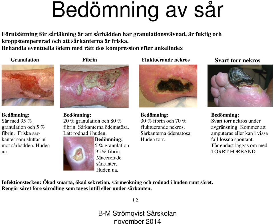 och 80 % 30 % fibrin och 70 % Svart torr nekros under granulation och 5 % fibrin. Sårkanterna ödematösa. fluktuerande nekros. avgränsning. Kommer att fibrin. Friska sår- Lätt rodnad i huden.
