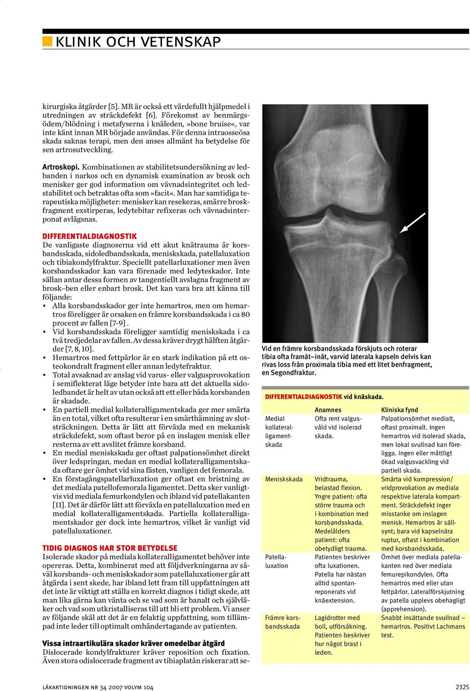 Förekomst av benmärgsödem/blödning i metafyserna i knäleden,»bone bruise«, var inte känt innan MR började användas.