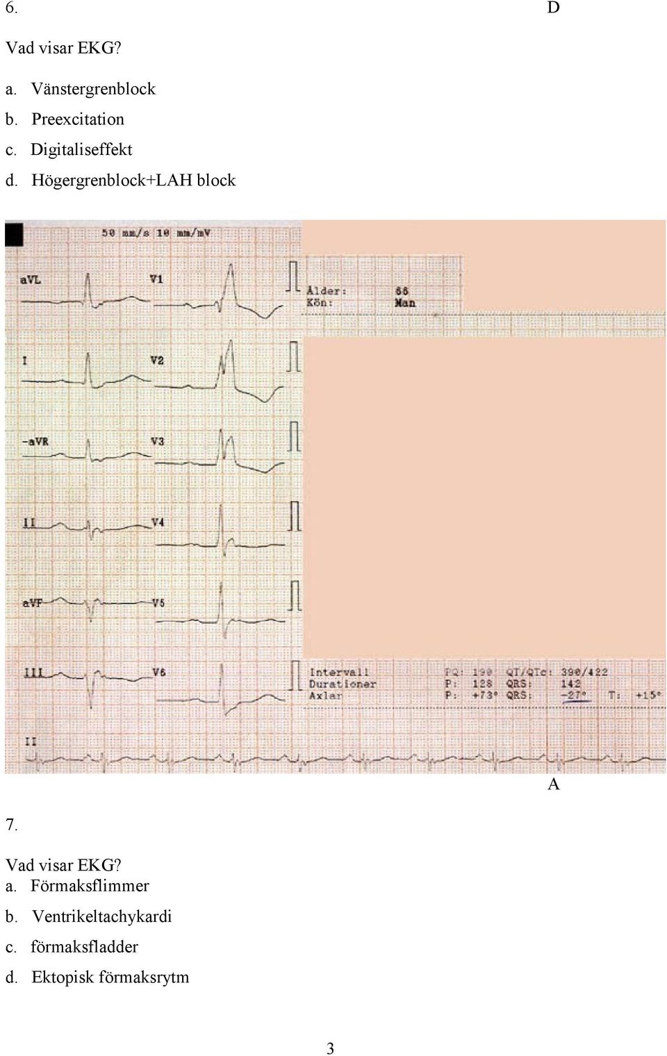 Högergrenblock+LH block 7. Vad visar EKG? a.