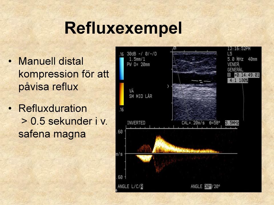 påvisa reflux