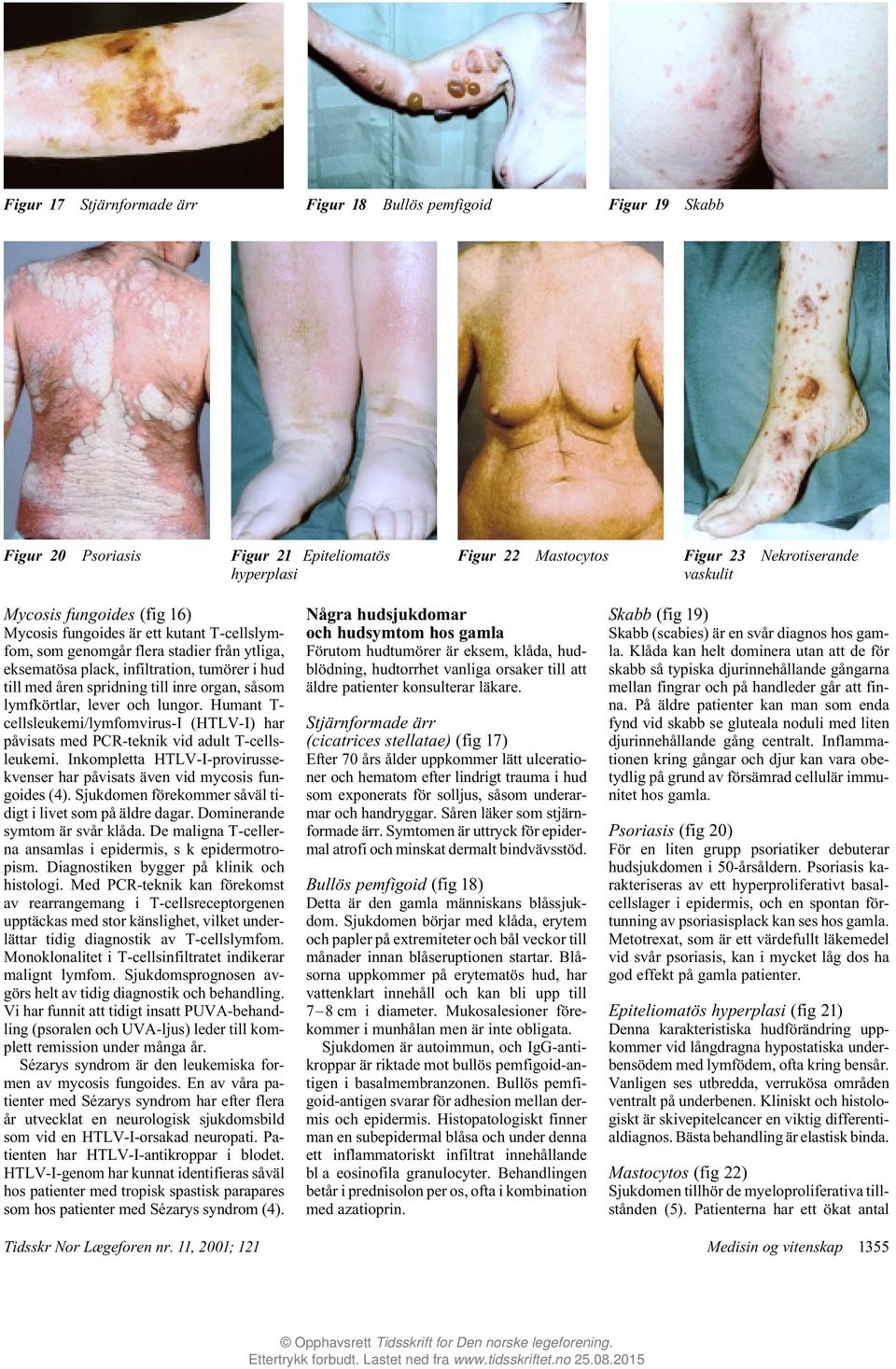 lever och lungor. Humant T- cellsleukemi/lymfomvirus-i (HTLV-I) har påvisats med PCR-teknik vid adult T-cellsleukemi. Inkompletta HTLV-I-provirussekvenser har påvisats även vid mycosis fungoides (4).