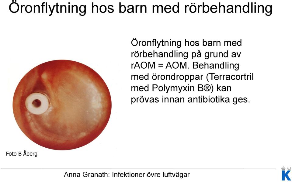 Behandling med örondroppar (Terracortril med