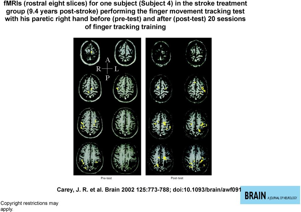 hand before (pre-test) and after (post-test) 20 sessions of finger tracking training