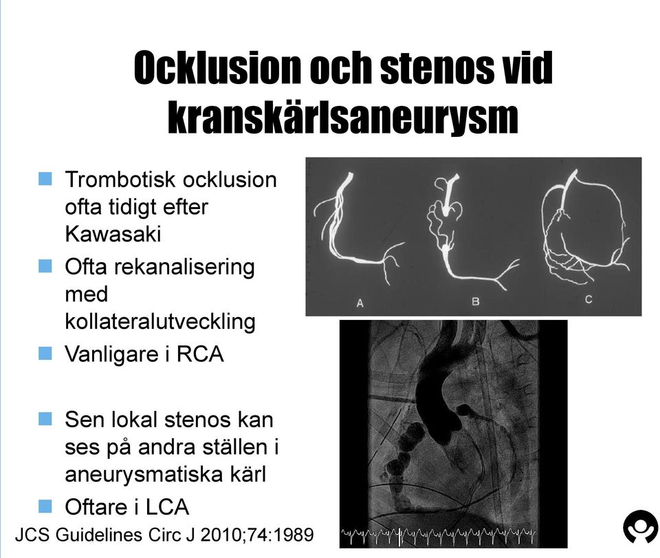 RCA kranskärlsaneurysm Sen lokal stenos kan ses på andra ställen