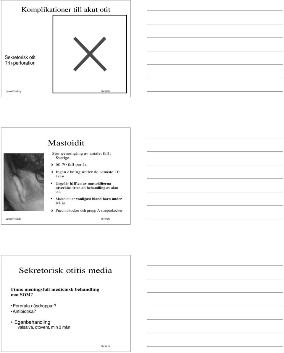 ó Ingen ö kning under de senaste 10 å ren Ungef är hä lften av mastoiditerna utvecklas trots ab behandling av akut otit