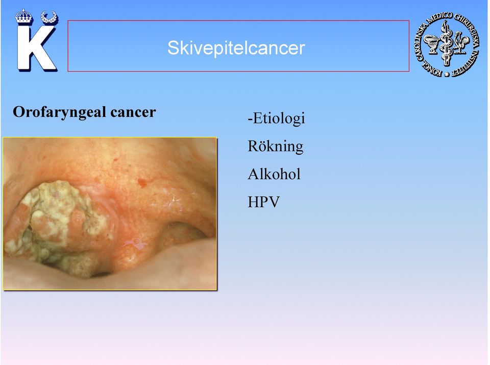 cancer -Etiologi