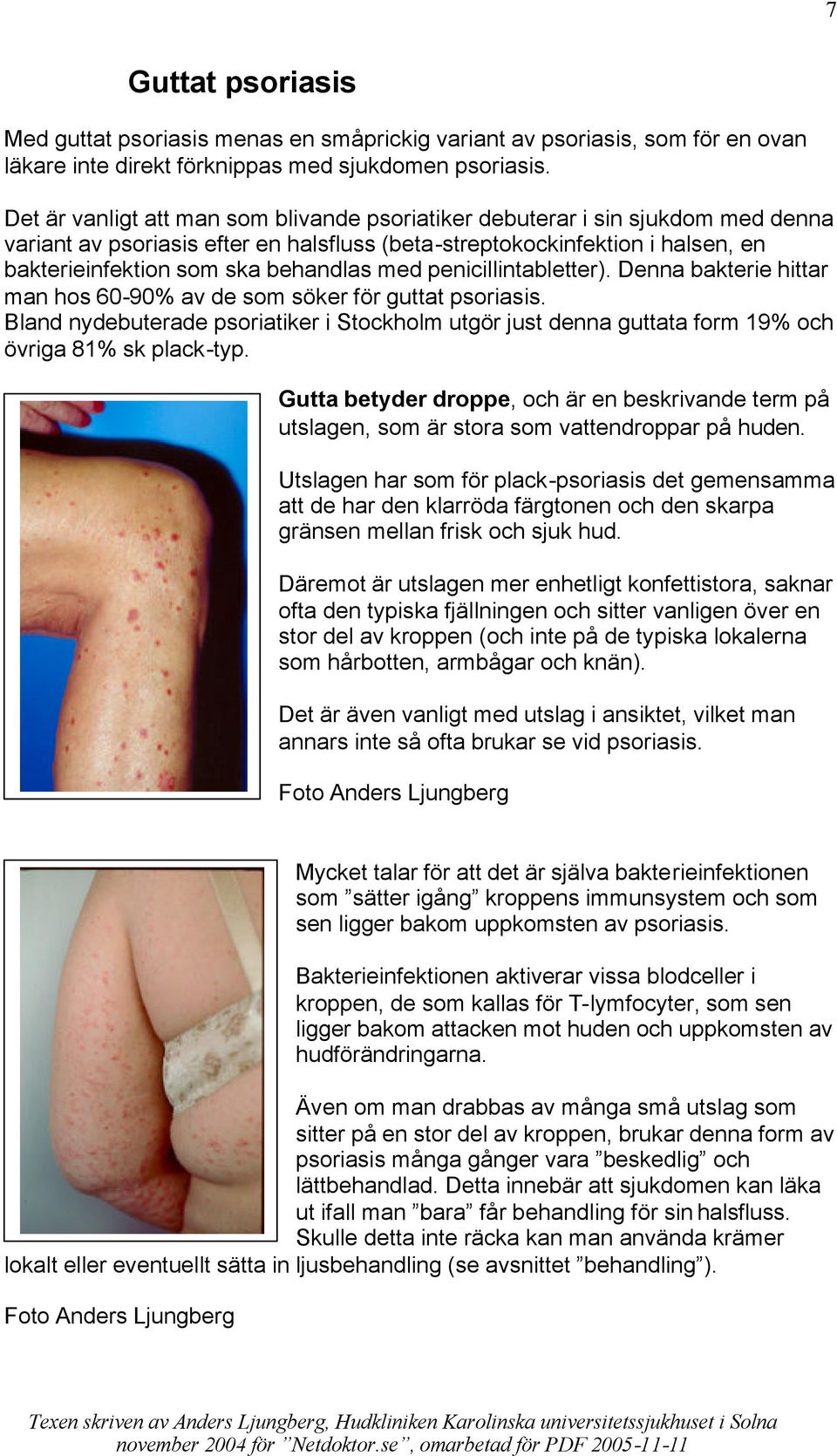 med penicillintabletter). Denna bakterie hittar man hos 60-90% av de som söker för guttat psoriasis.