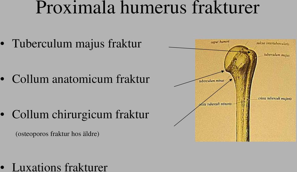 fraktur Collum chirurgicum fraktur