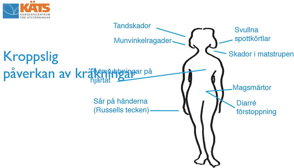 på händerna (Russells tecken)" Svullna