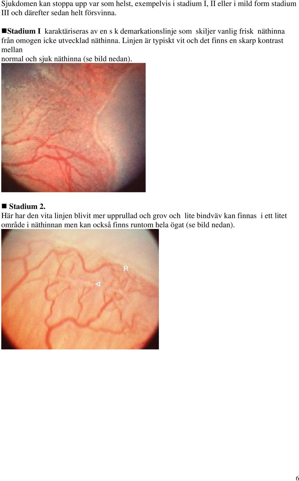 Linjen är typiskt vit och det finns en skarp kontrast mellan normal och sjuk näthinna (se bild nedan). Stadium 2.