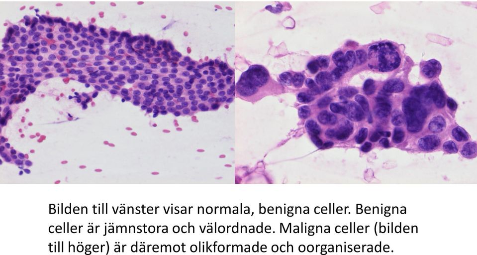 Benigna celler är jämnstora och välordnade.