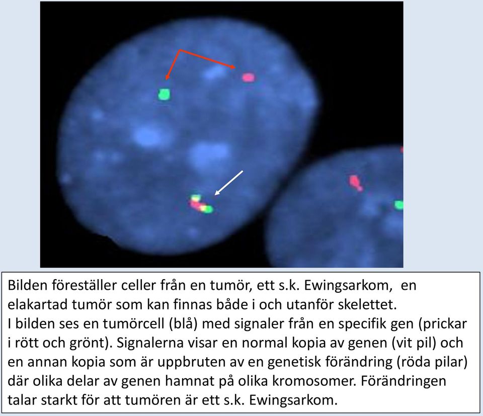 I bilden ses en tumörcell (blå) med signaler från en specifik gen (prickar i rött och grönt).