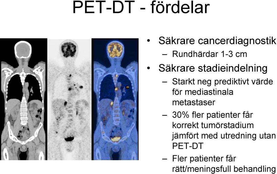 mediastinala metastaser 30% fler patienter får korrekt