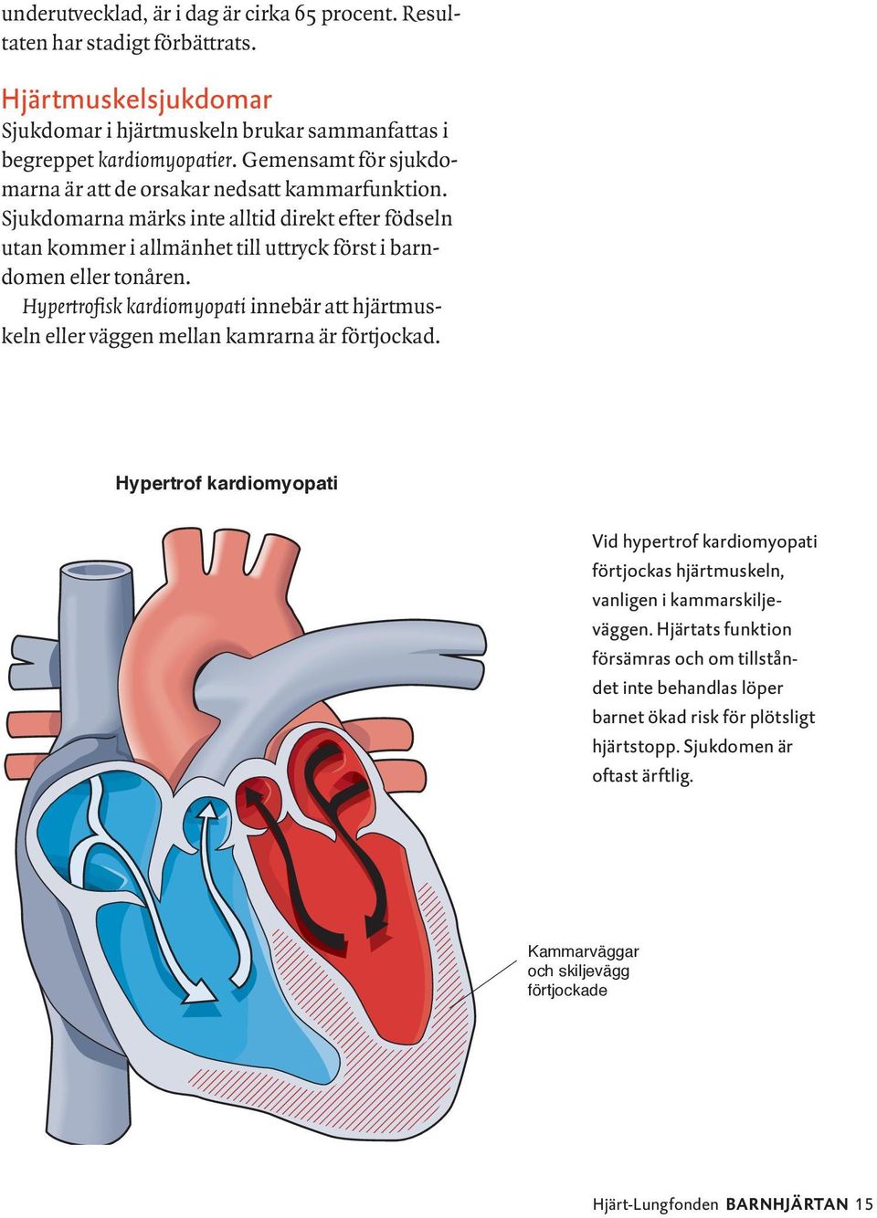 Hypertrofisk kardiomyopati innebär att hjärtmuskeln eller väggen mellan kamrarna är förtjockad.